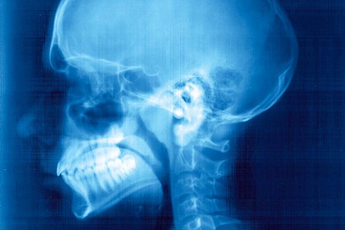 X-ray External otitis (swimmer’s ear)