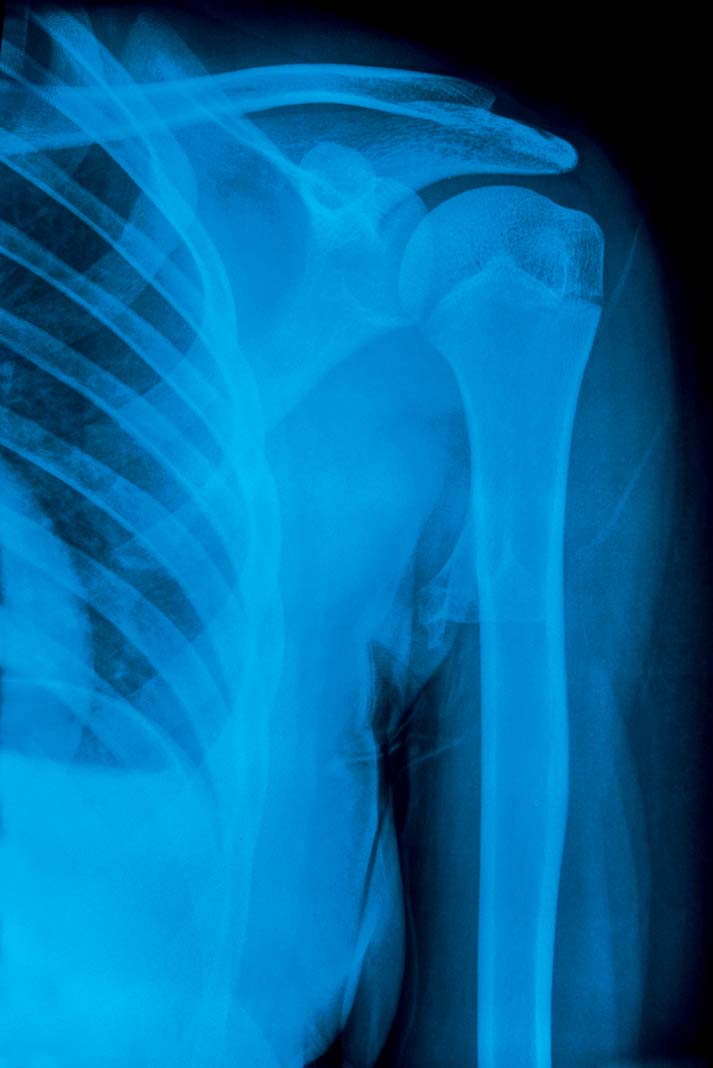 Dislocated shoulder (anterior)