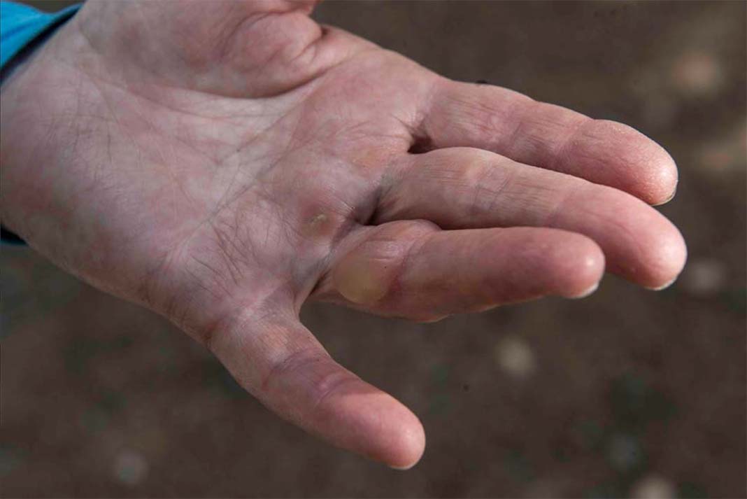person's hand with a blister