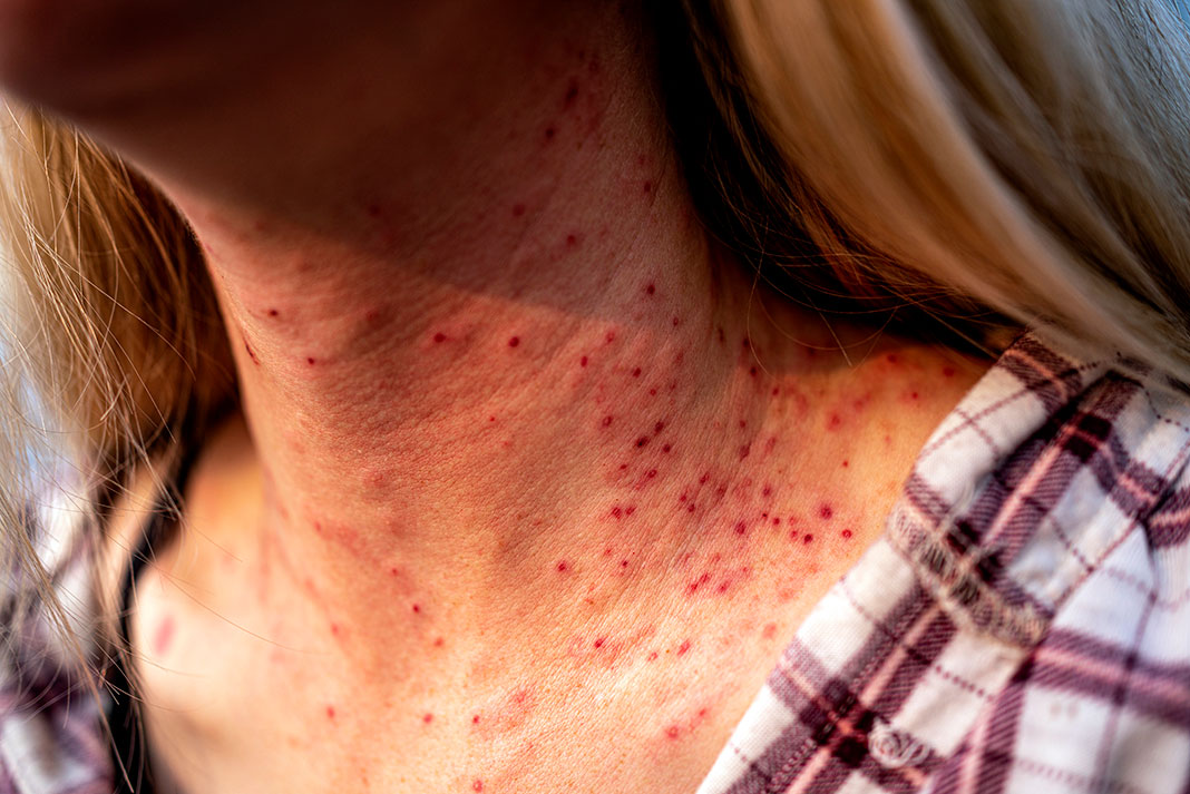 a woman's neck is covered in black fly bites during a canoe expedition to Hudson Bay