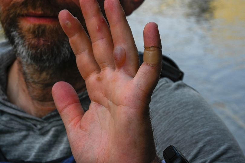 Blister on man's hand from long-distance paddling.